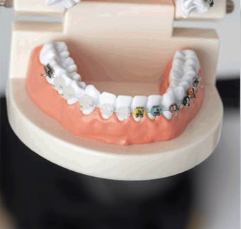 a model of teeth with braces